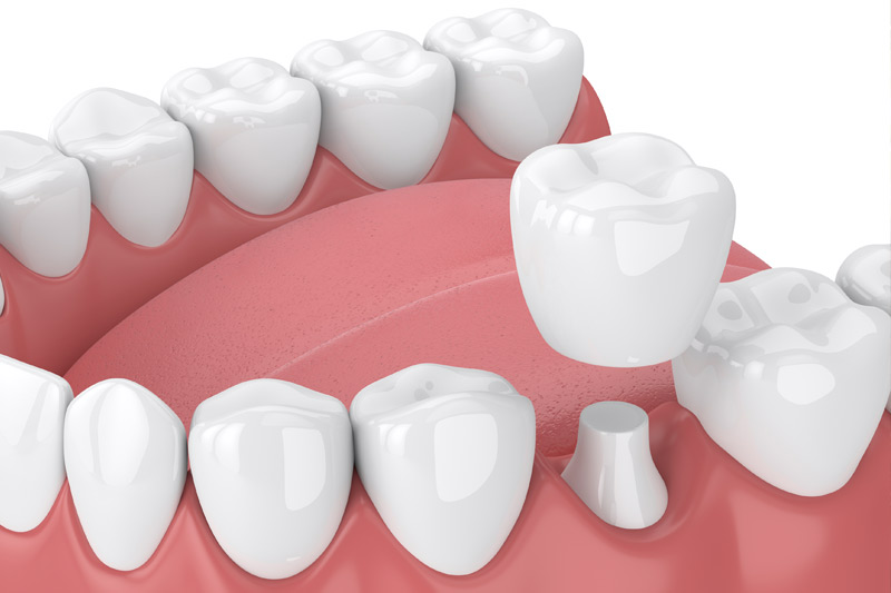 Emergency Dentist in Coronado