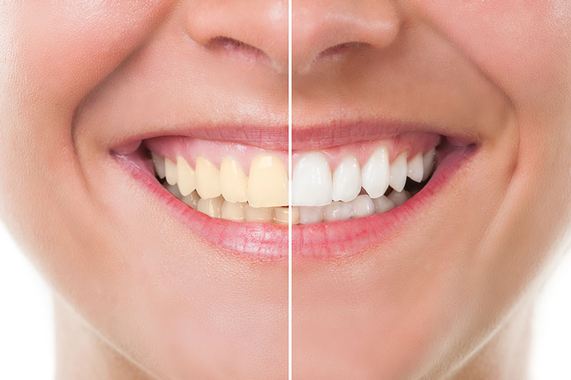 Teeth Whitening in Coronado